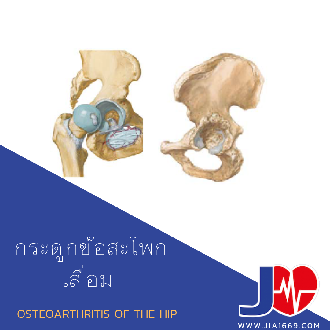 OSTEOARTHRITIS OF THE HIP 