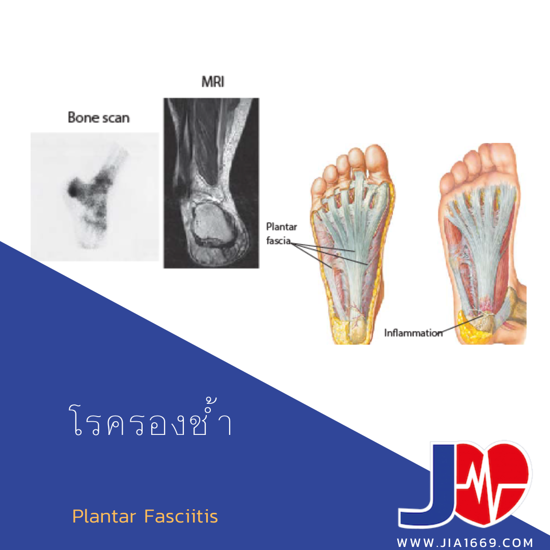 Plantar Fasciitis