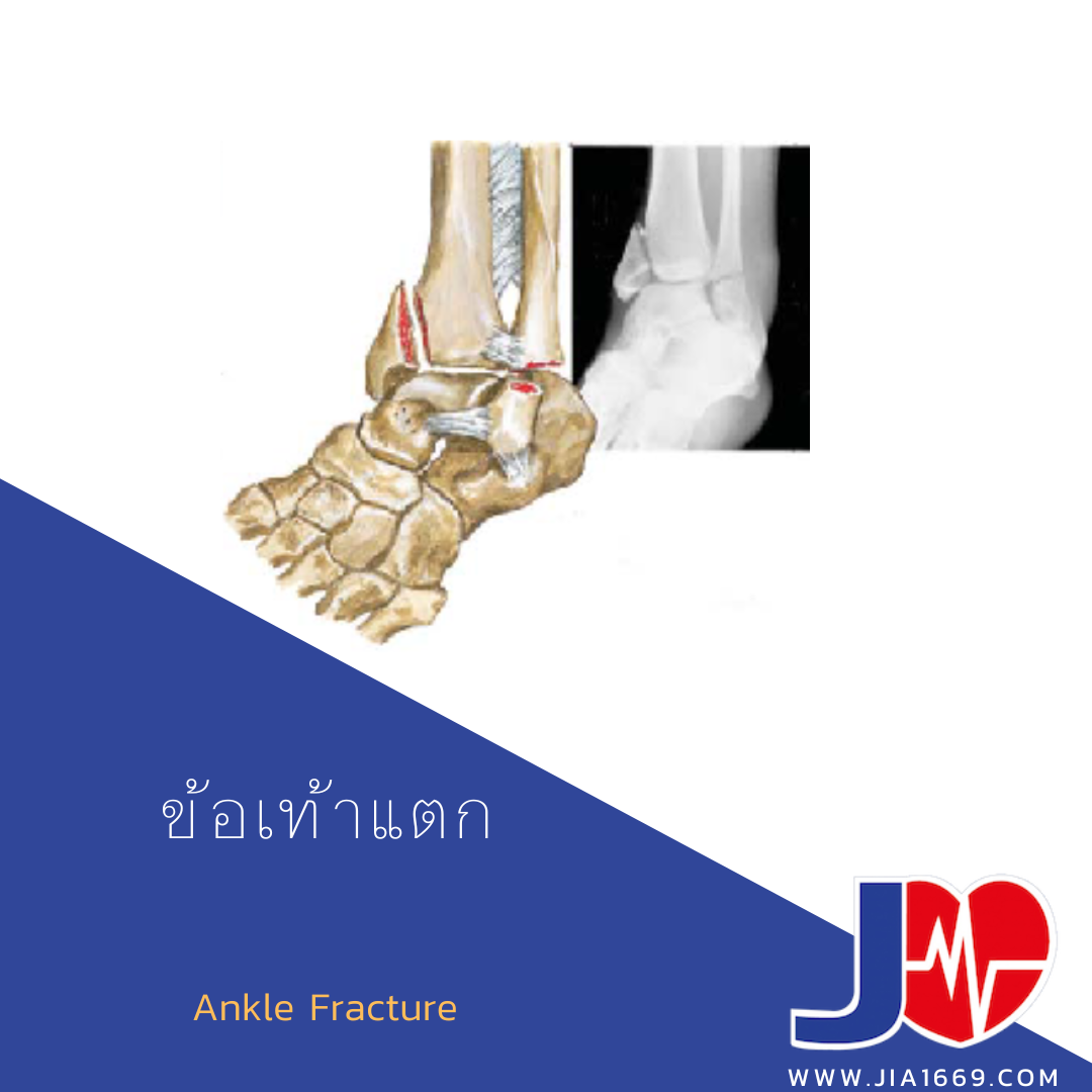 Ankle Fracture 