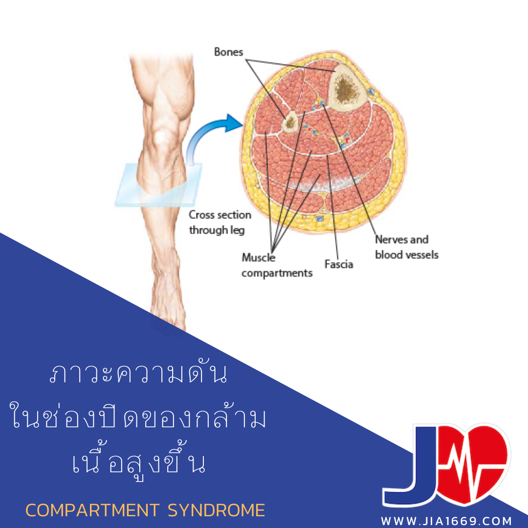 COMPARTMENT SYNDROME 