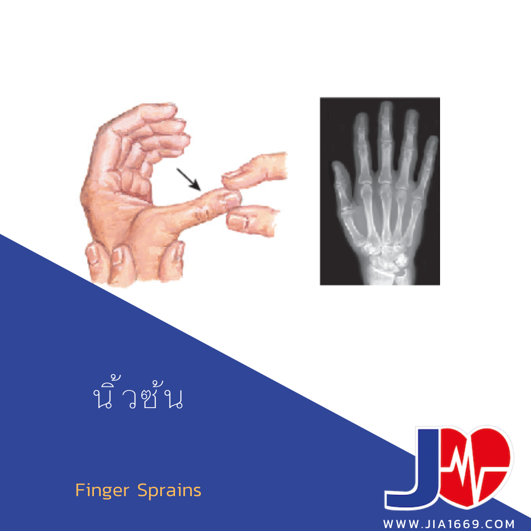 Finger Sprains 