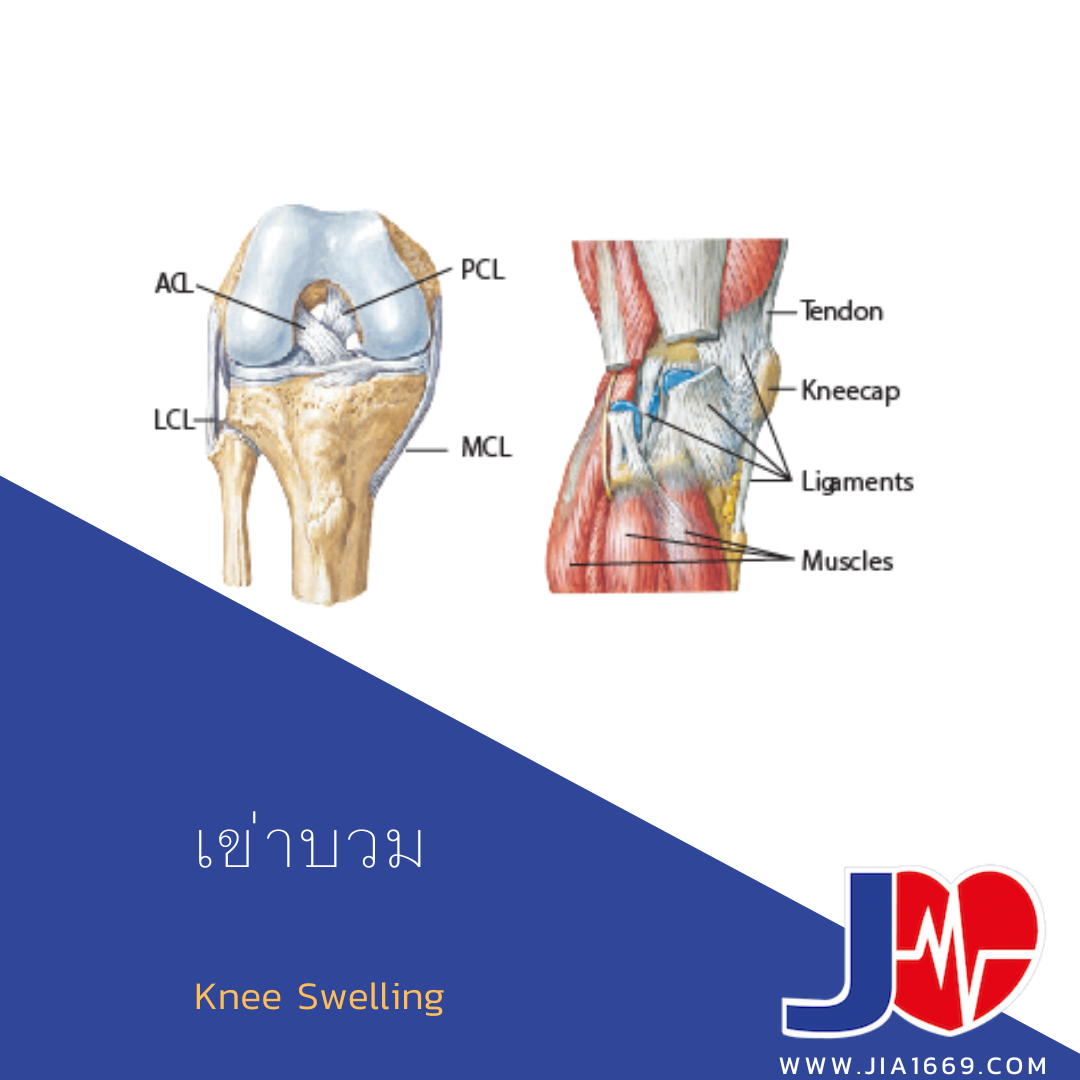 Knee Swelling