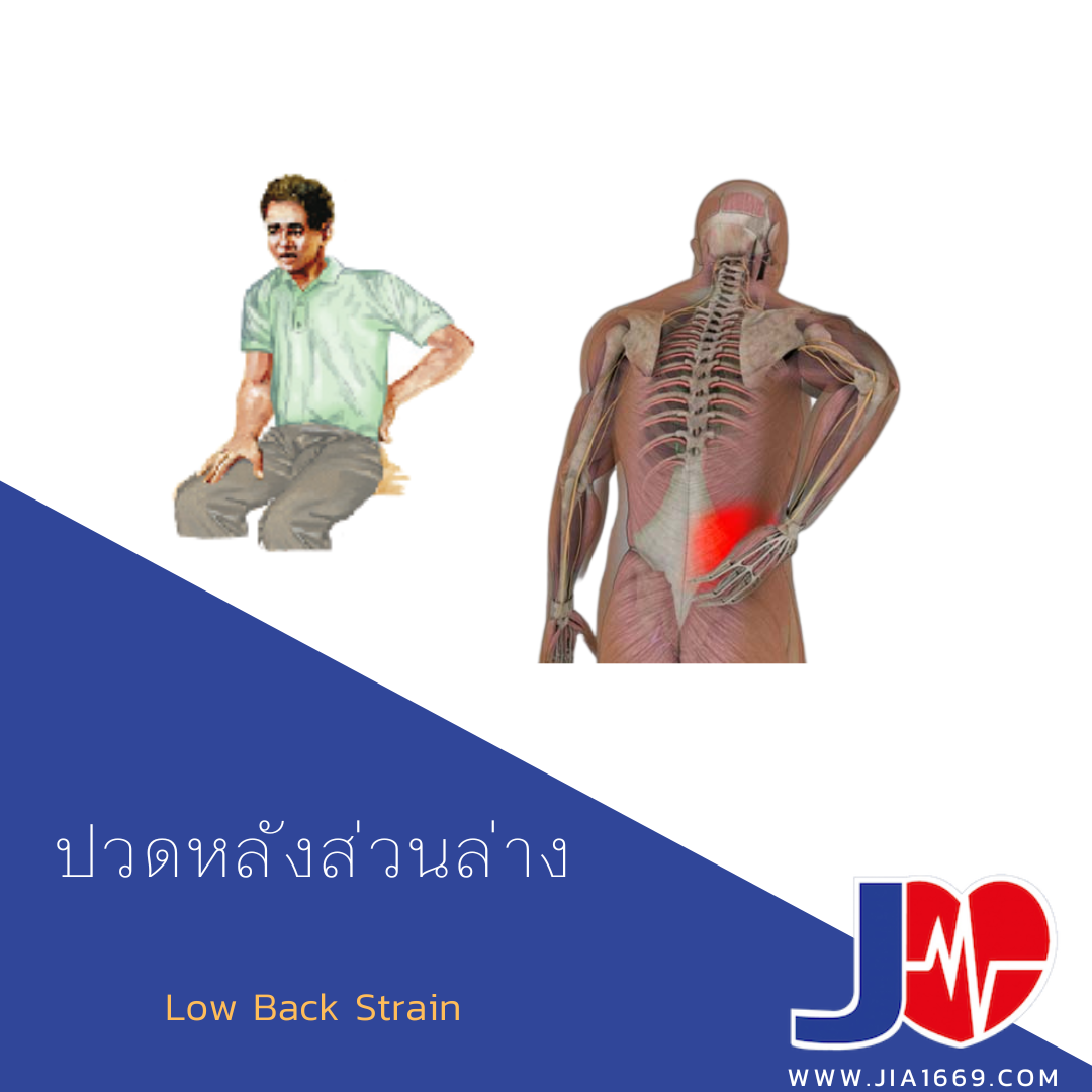 Low Back Strain 