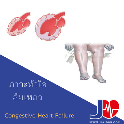 CONGESTIVE HEART FAILURE (CHF)