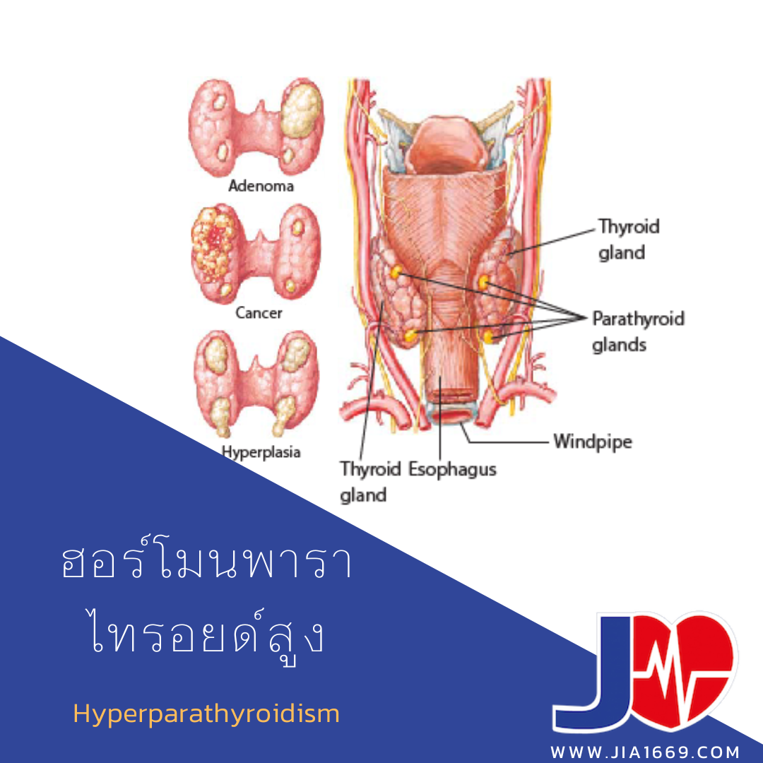 Hyperparathyroidism 