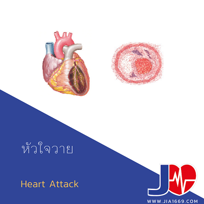 Heart Attack