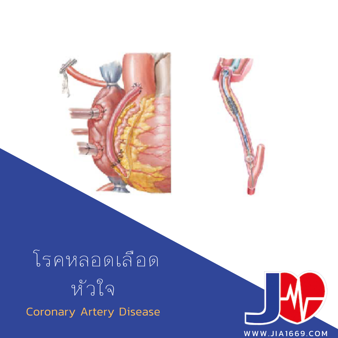 โรคหลอดเลือดหัวใจ