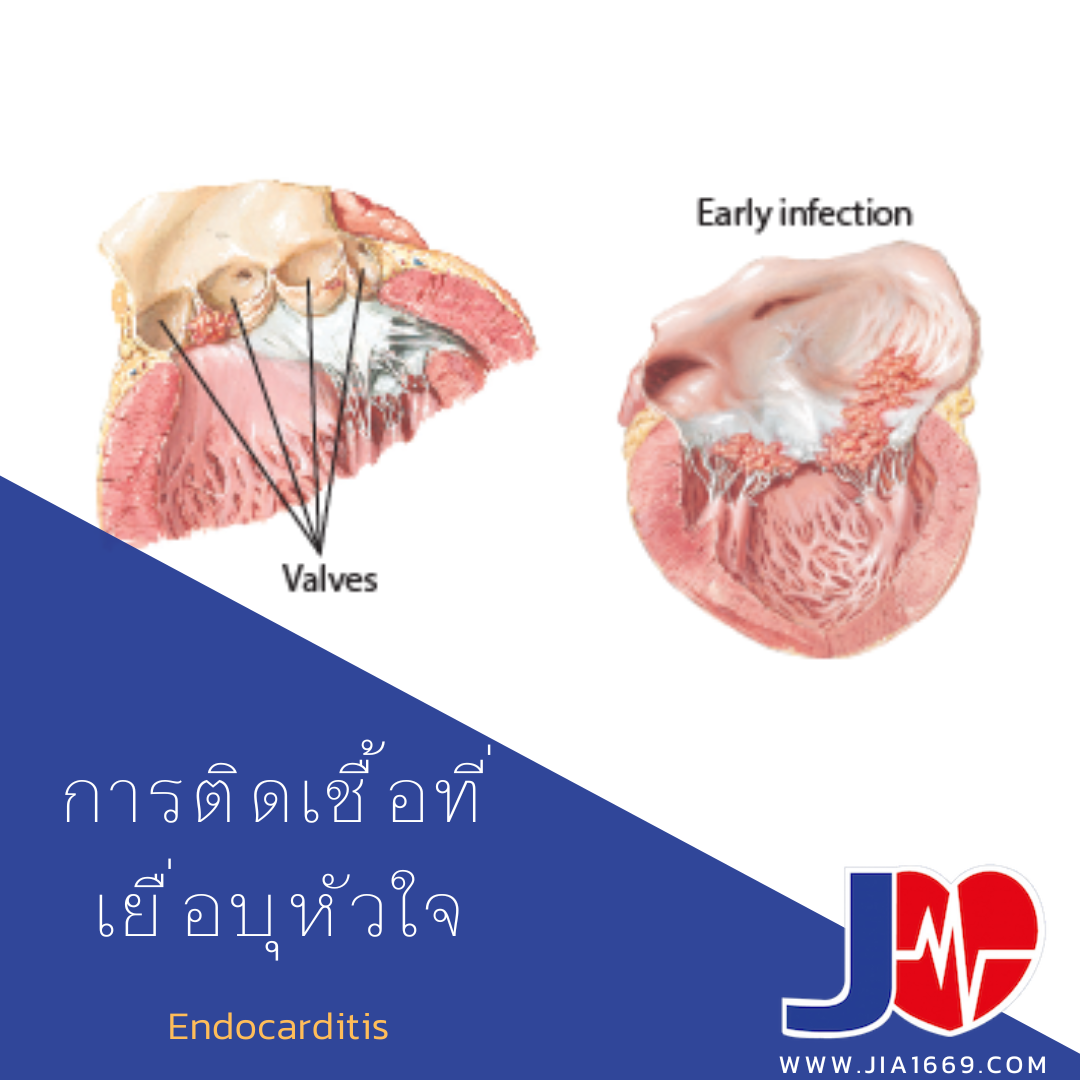 Endocarditis 