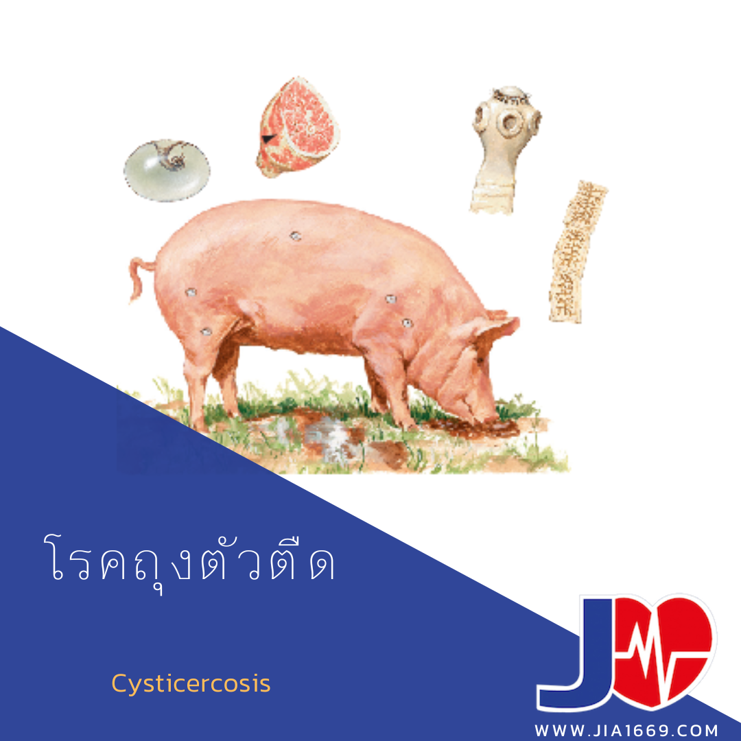 Cysticercosis 