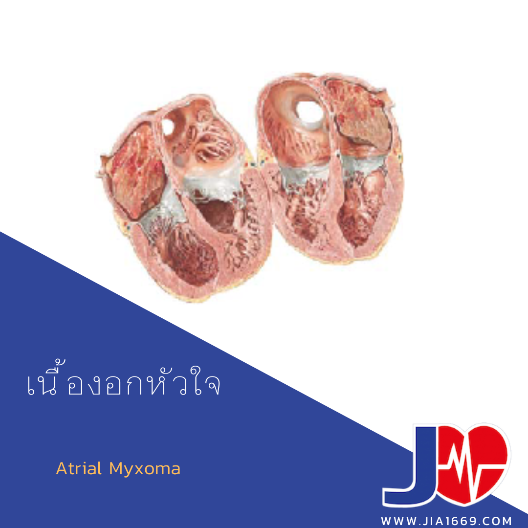 Atrial Myxoma 