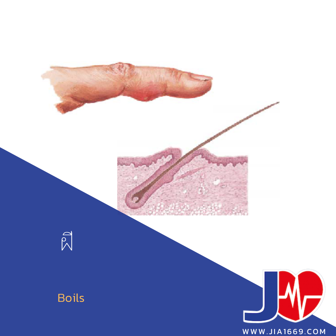 ฝี - jia1669