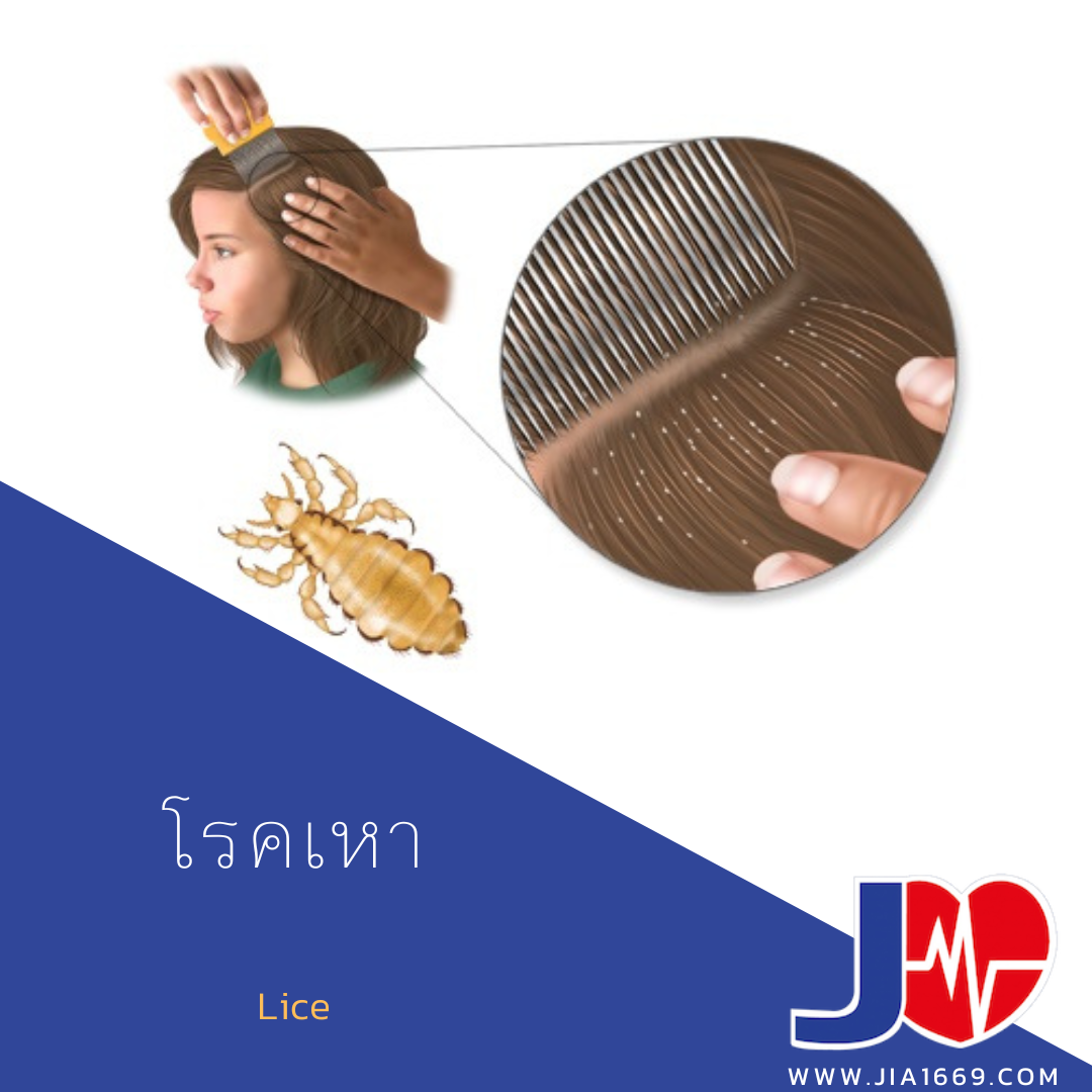  Lice