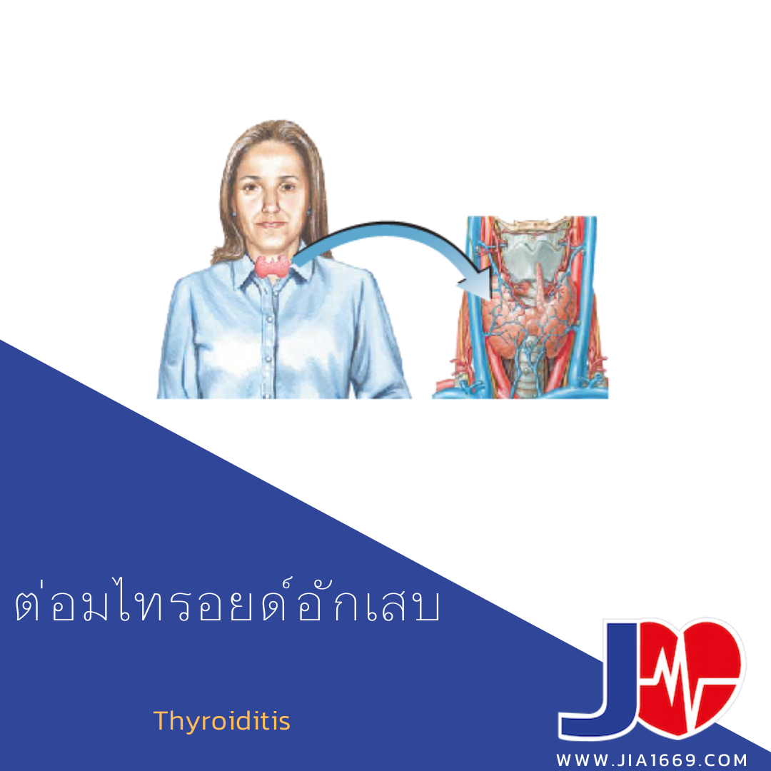 Thyroiditis 