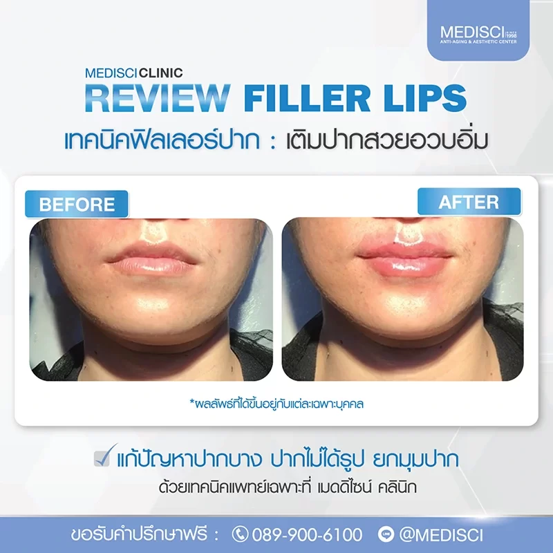 Belotero Lips Review