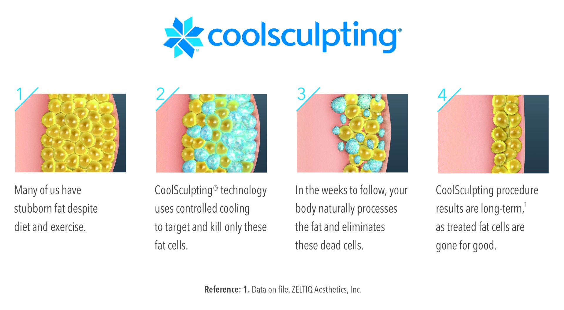 Coolsculpting