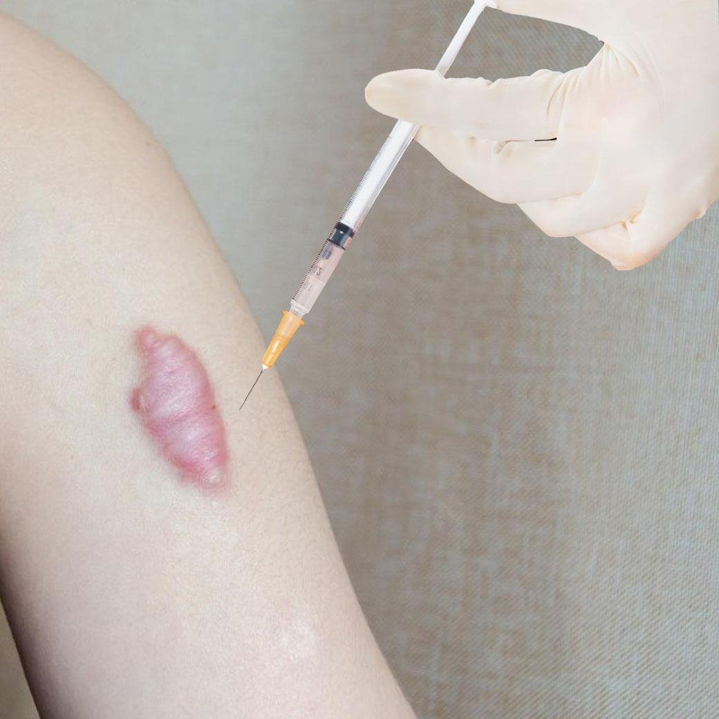 keloid injection