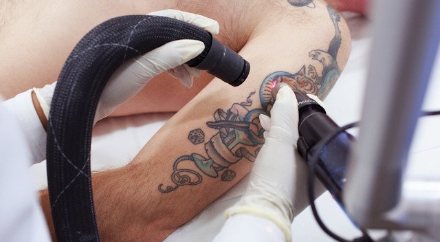 tattoo removal