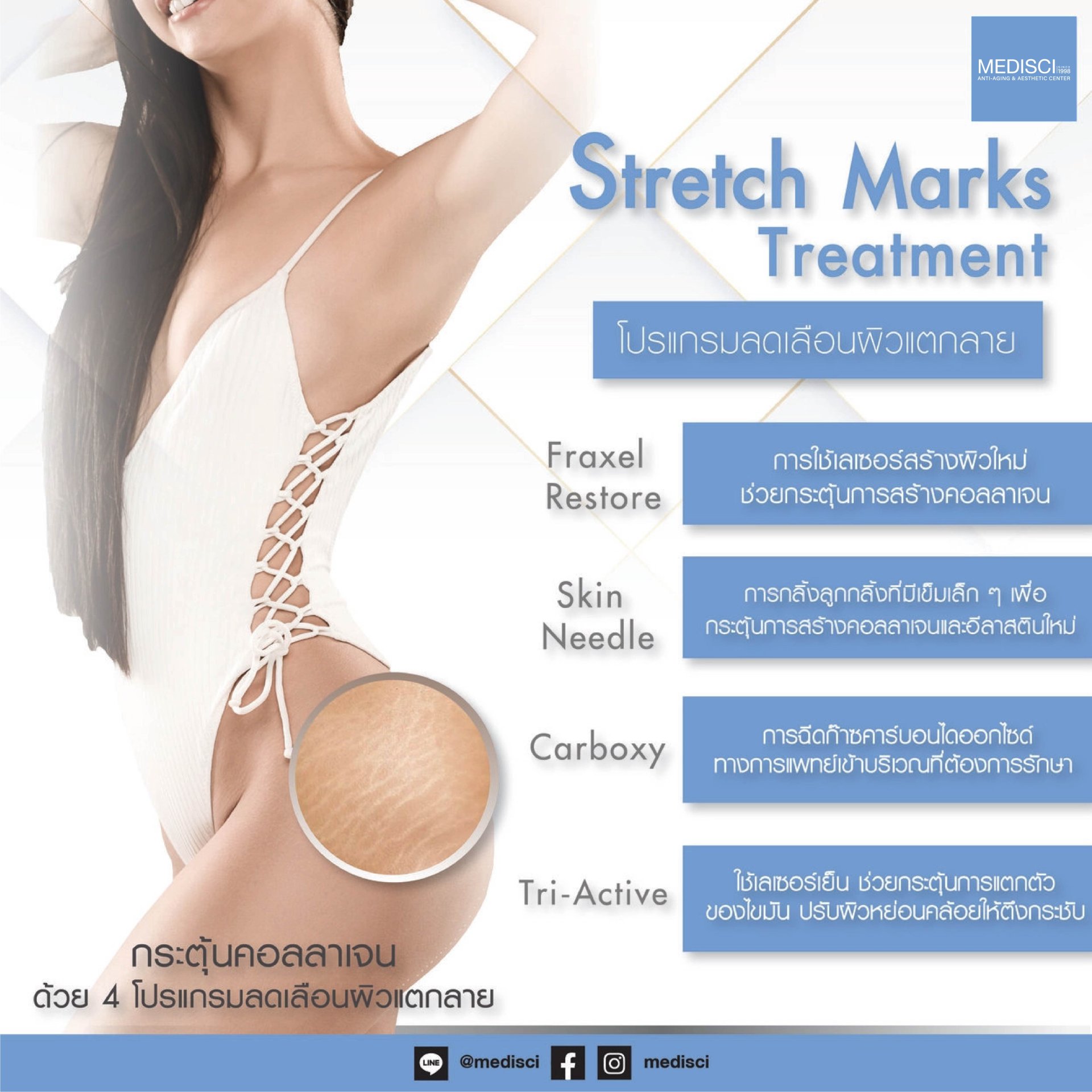 Stretch Marks Treatment - The Center for Women's Aesthetics