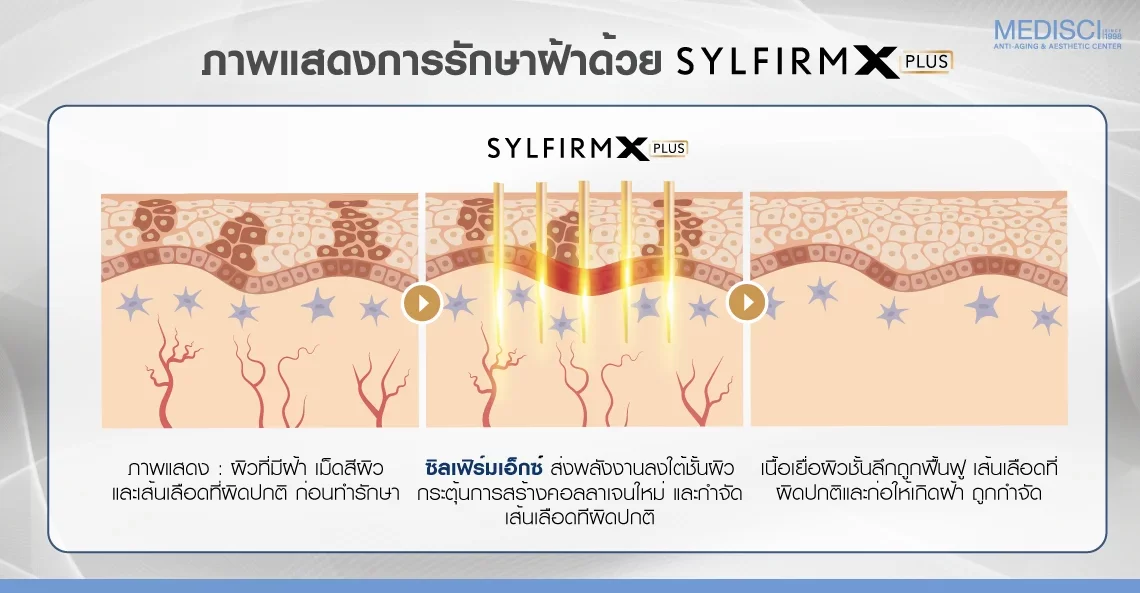 การรักษาฝ้า กับ Sylfirm X Plus