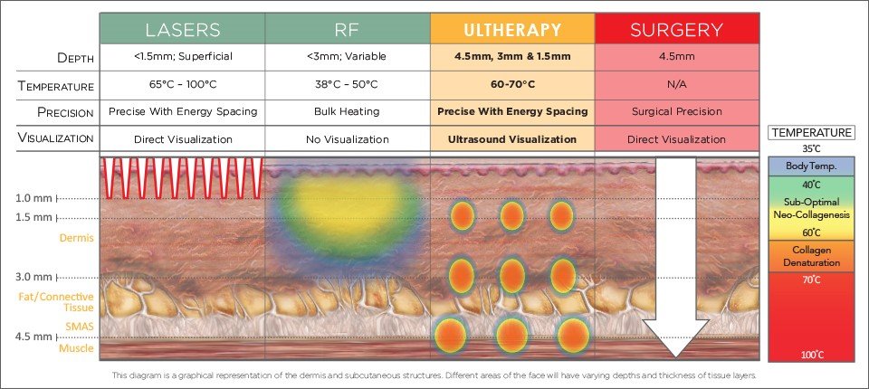 Ultherapy