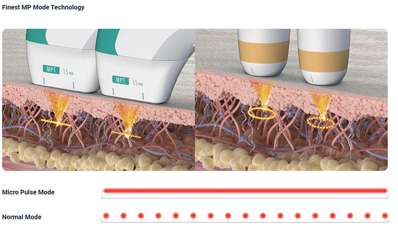 Teknologi Mode MP Terbaik