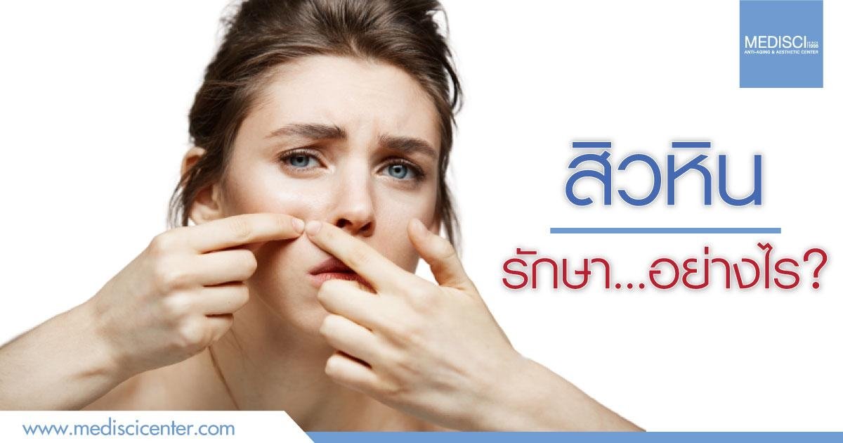 สิวหิน รักษา