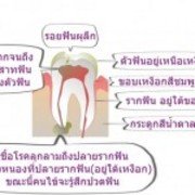 รักษารากฟัน - Ruamdental