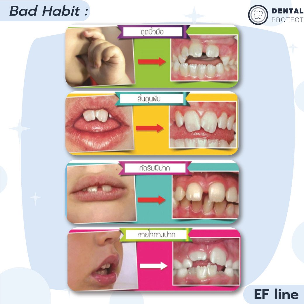 EF Line คืออะไร? l คลินิกทันตกรรมเดนทัลโพรเทค มหาสารคาม - dentalprotectmhk