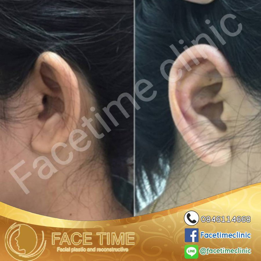 การผ่าตัดบริเวณหู (Cosmetic Surgery For Ears)