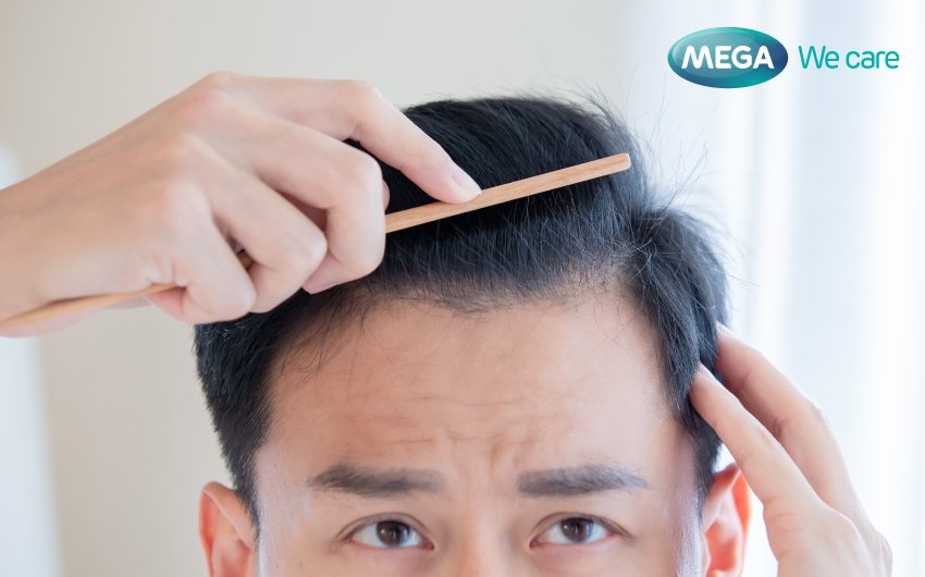 ทางเลือกใหม่ ลดผมร่วงในผู้ชายด้วยสมุนไพรธรรมชาติ - Mega We Care - Megawecare