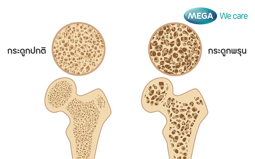 normal-bone-and-osteoporosis