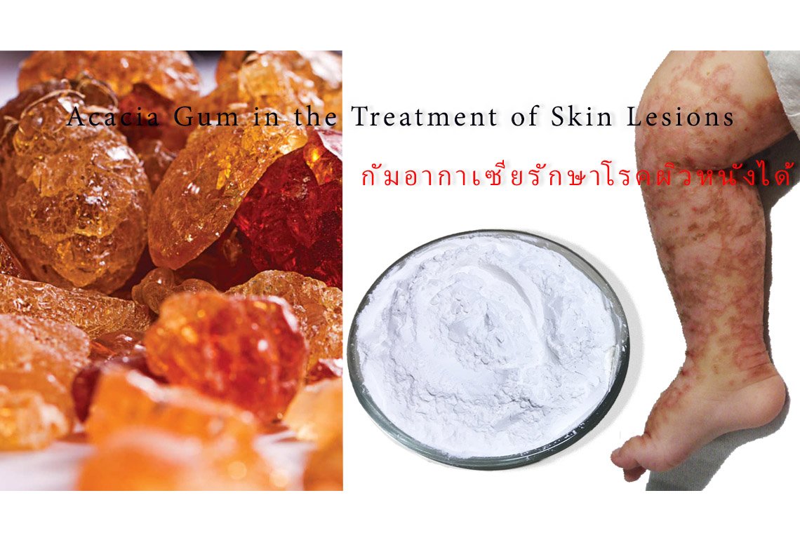 Use of Acacia Gum in the Treatment of Skin Lesions - jumbo-th