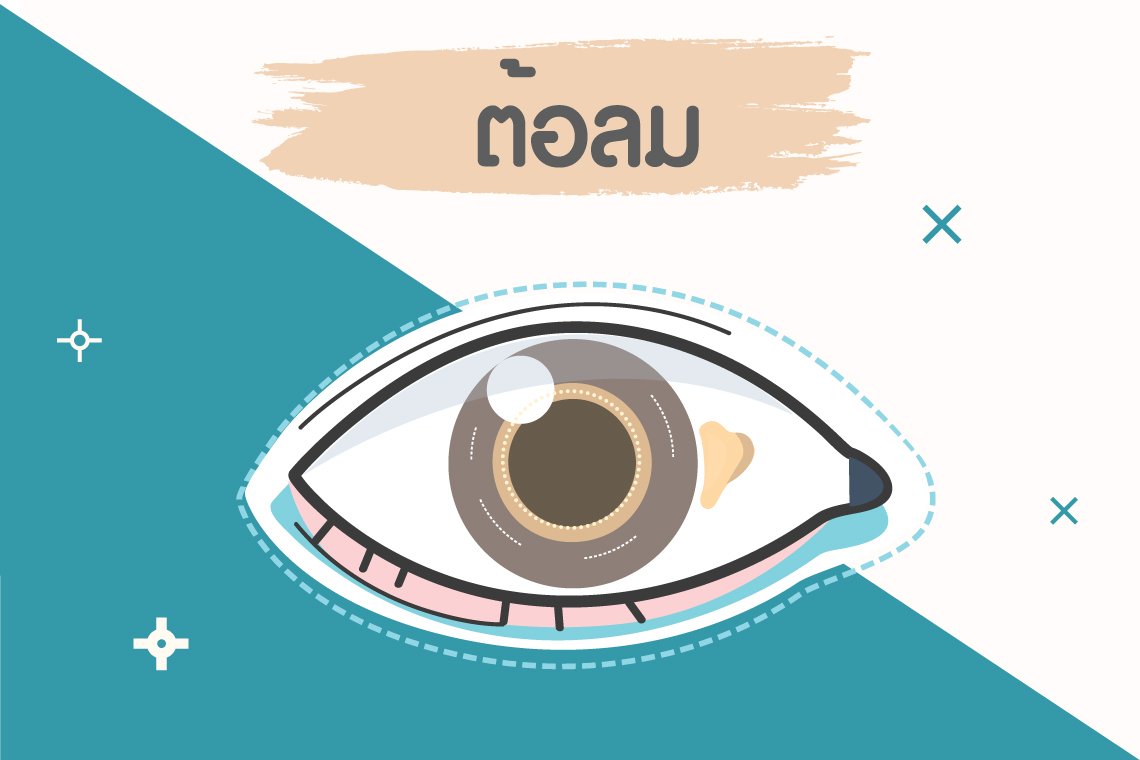 " ต้อลม "