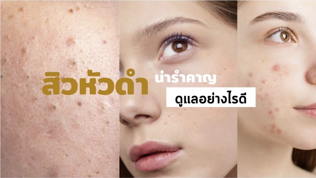  จุดดำเล็กบนใบหน้าแก้ปัญหาอย่างไรดี?