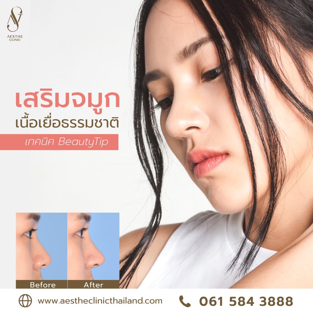 รีวิว เสริมจมูกด้วยซิลิโคน สันสโลป ปลายเชิด - Aesthe Clinic