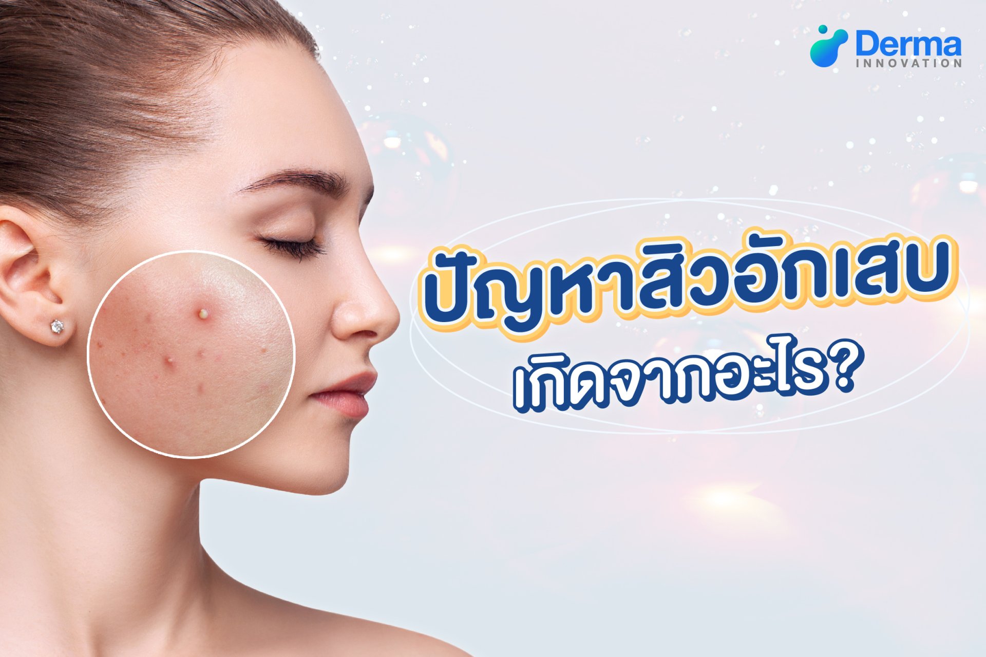 ปัญหาสิวอักเสบ เกิดจากอะไร ? ดูแลแบบไหนไม่ให้ทิ้งรอย