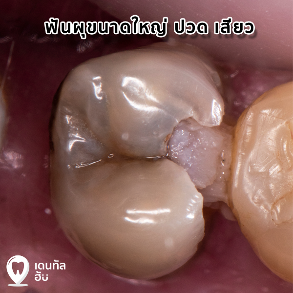 รักษารากฟัน มีคุณหมอเฉพาะทางดูแล - Dentalhubclinic