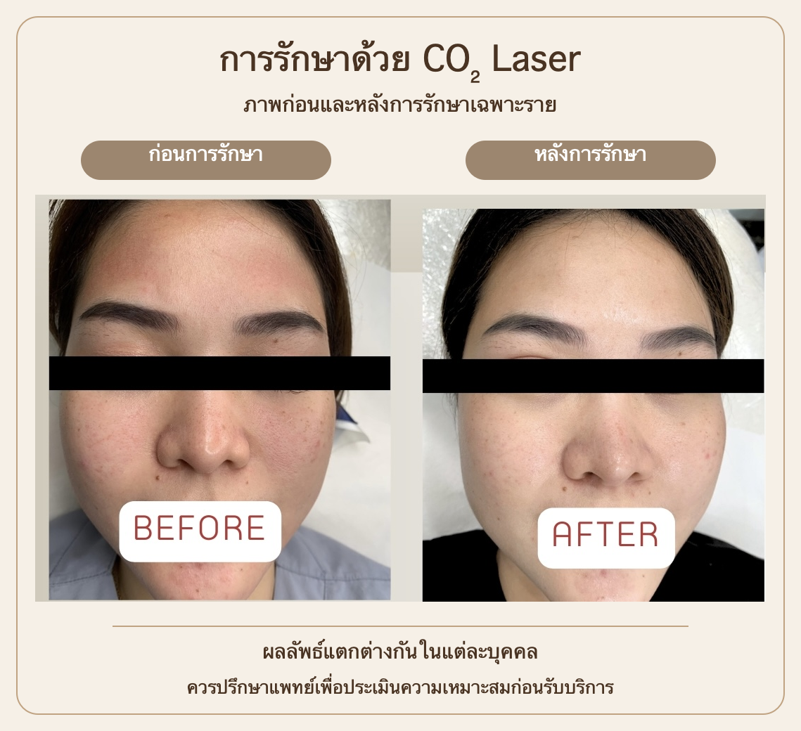 ภาพก่อนและหลัง CO2 Laser บริเวณใบหน้า ผลลัพธ์เฉพาะราย