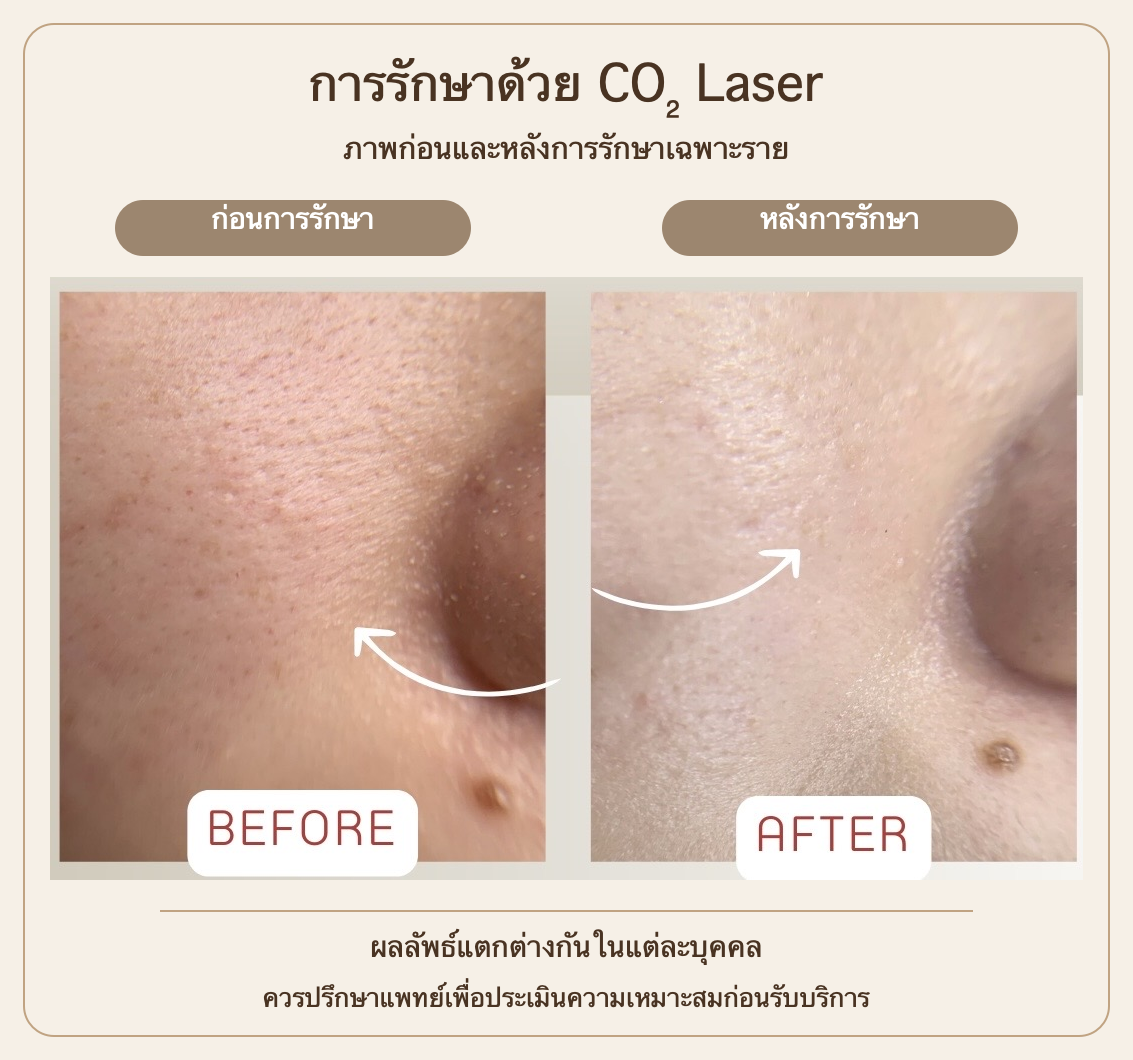 Close-up cheek photographs before and after CO2 laser in an individual case