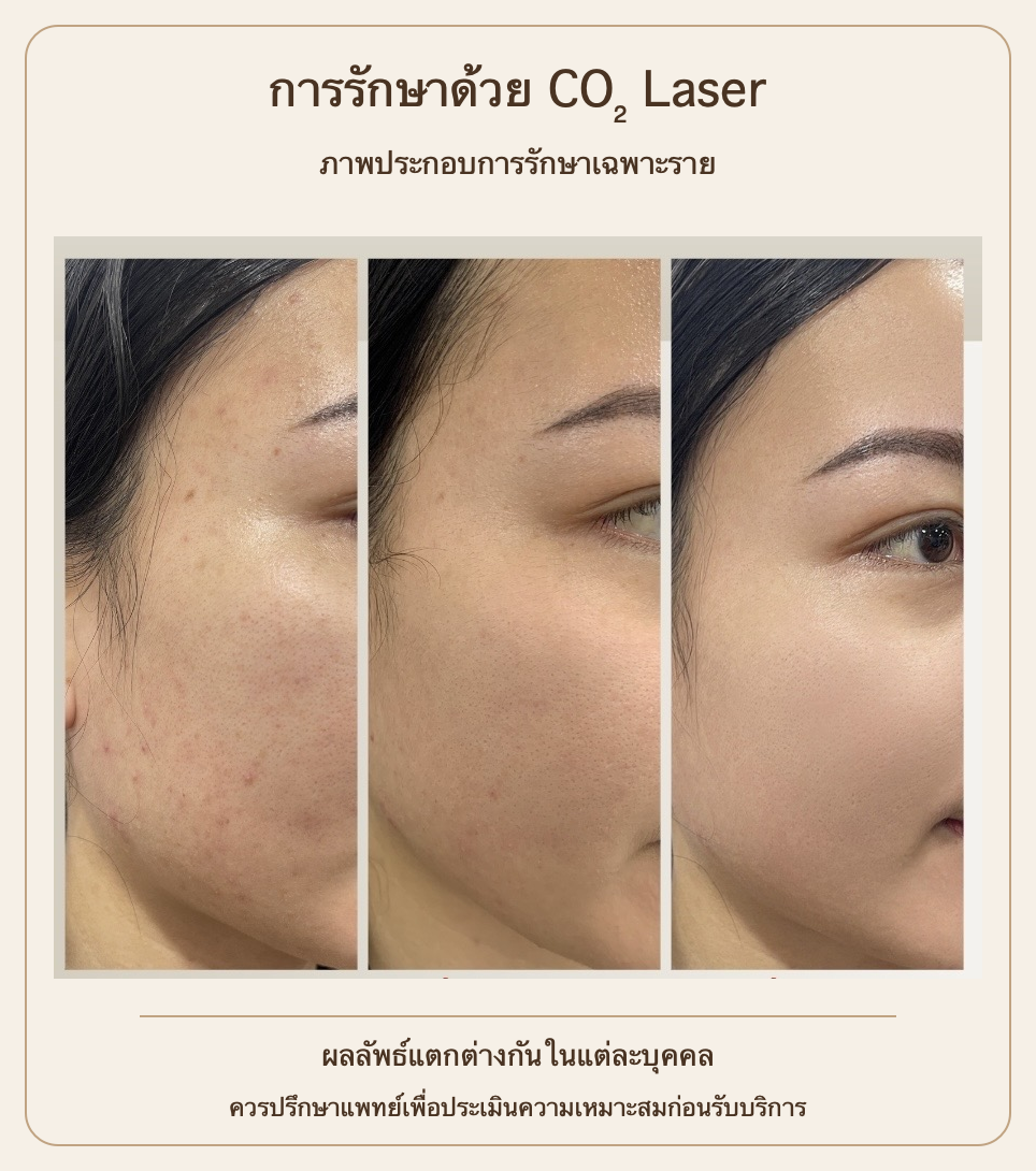 ภาพประกอบ CO2 Laser บริเวณแก้มสามมุม ผลลัพธ์แตกต่างกันในแต่ละบุคคล