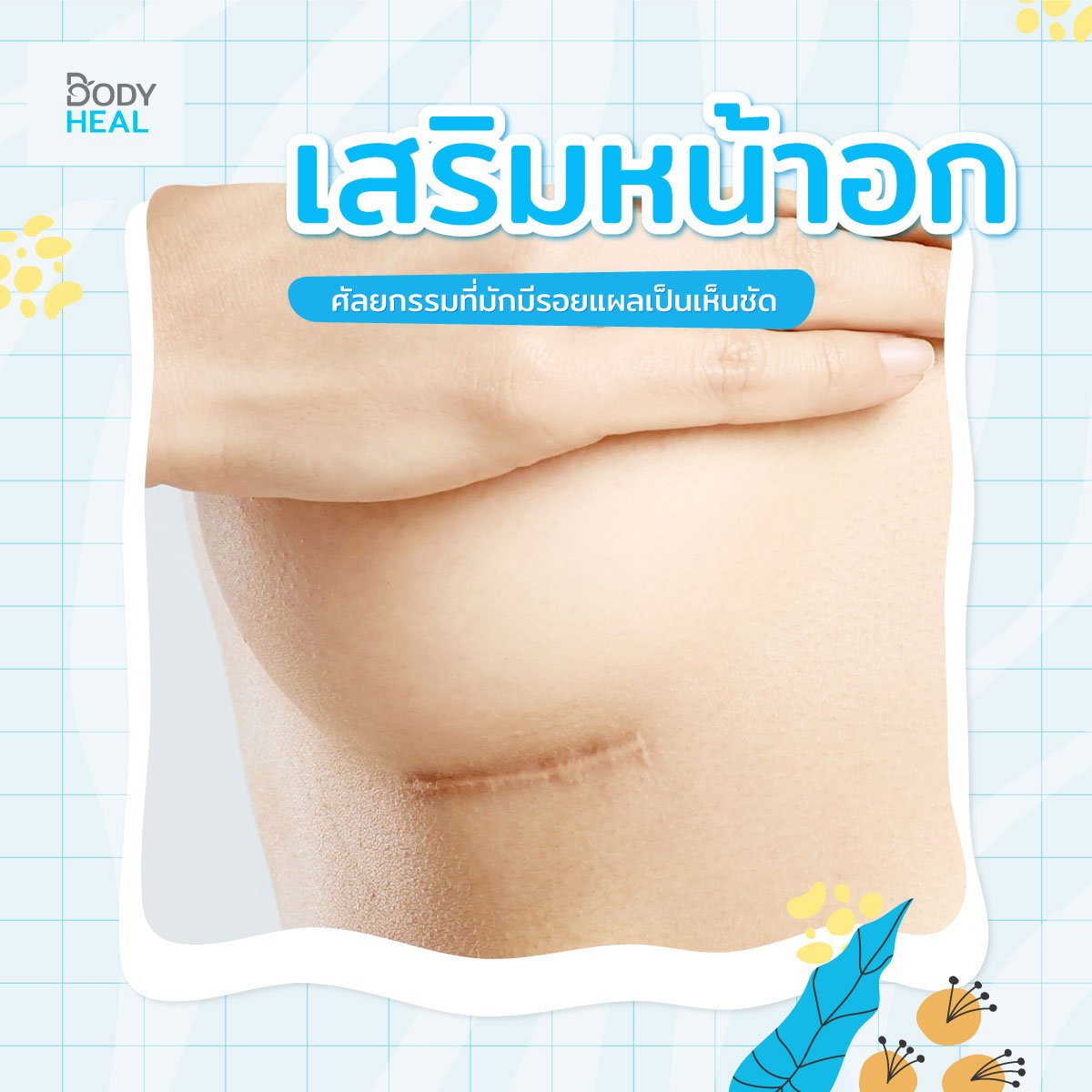 รอยแผลเป็นหน้าอก