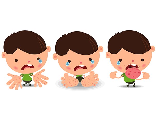 โรคมือเท้าปาก โรคมือเท้าปาก