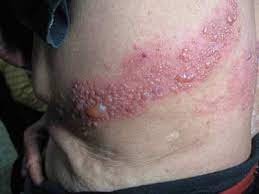 蛇串疮-病案 蛇串疮-病案