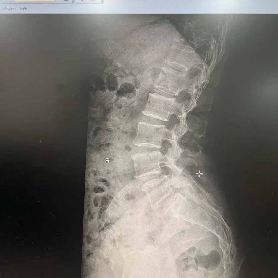 病例报告：慢性膝痛可能不仅仅是骨关节炎