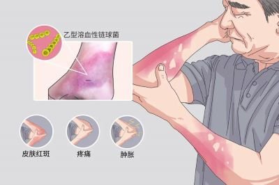 泰国华侨中医院黄紫薇中医师讲解丹毒的治疗方法