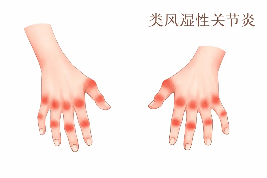杨桂莲中医师解析： 关节疼痛是否等同于类风湿性关节炎？