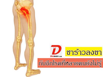 ชาร้าวลงขา อย่าพึ่งคิดว่าเป็นหมอนรองกระดูกทับเส้น ชาร้าวลงขา อย่าพึ่งคิดว่าเป็นหมอนรองกระดูกทับเส้น