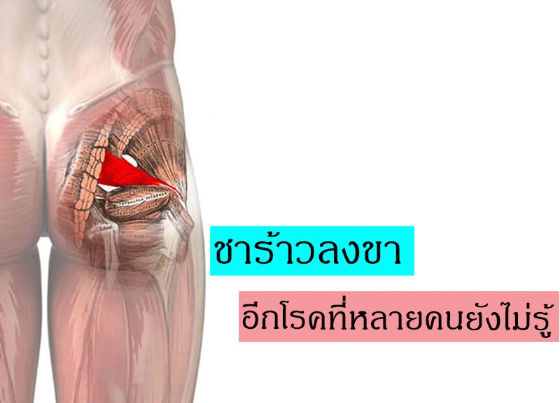 ปวดสะโพกร้าวลงขา กินยาก็ไม่หาย ปวดสะโพกร้าวลงขา กินยาก็ไม่หาย