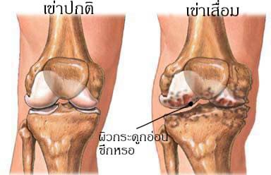 เสียงเตือน...จากอาการปวดเข่า