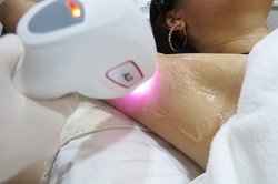 White Smooth Armpit Laser with The Scarlett Siam Paragon
